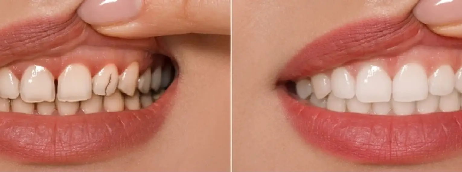 dental veenerf