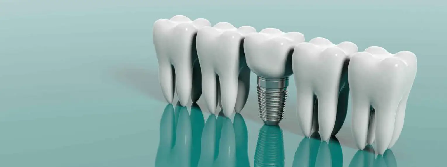 dentist implant